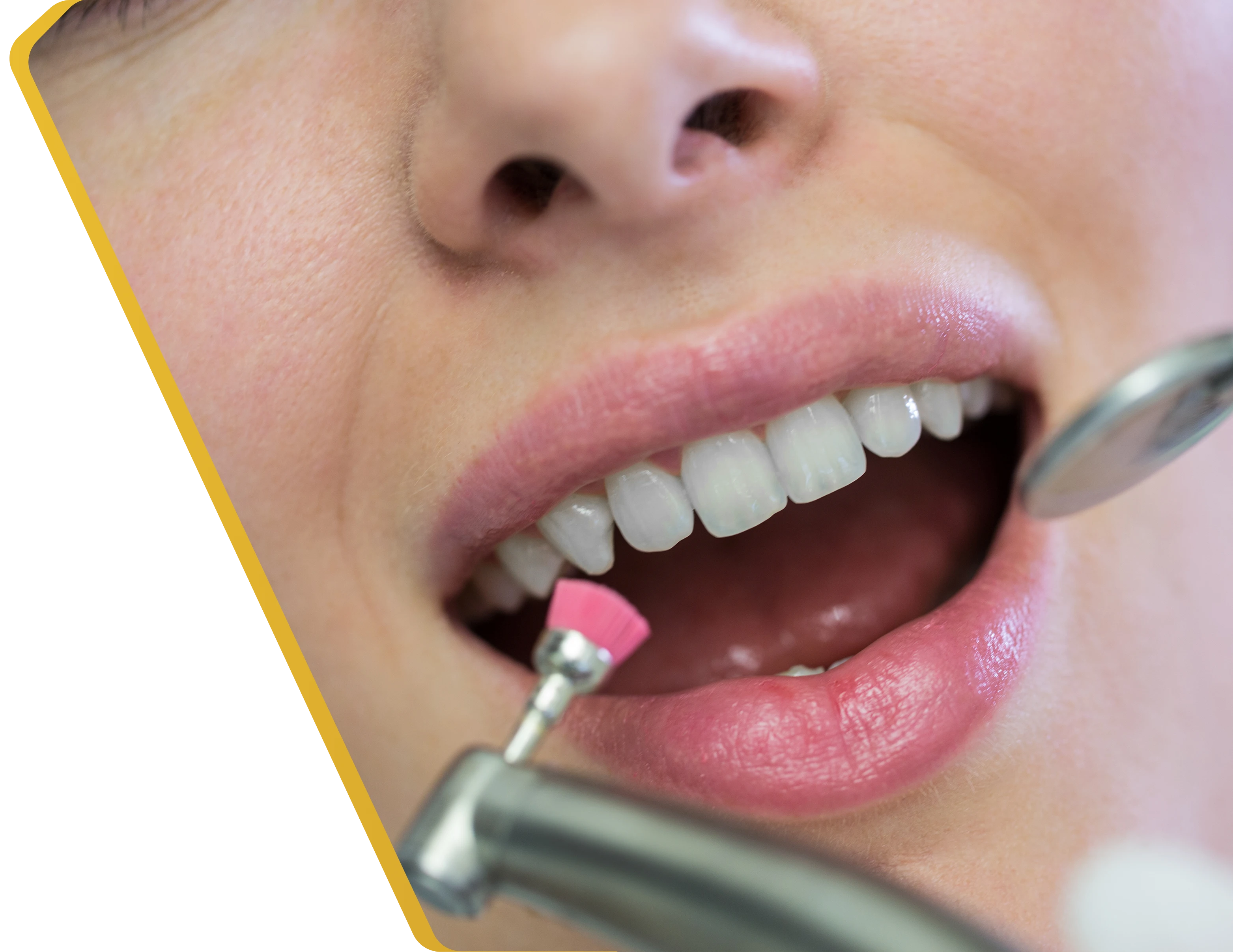 A patient receiving a quick fluoride treatment at Dentistry at Millennium Park in Chicago