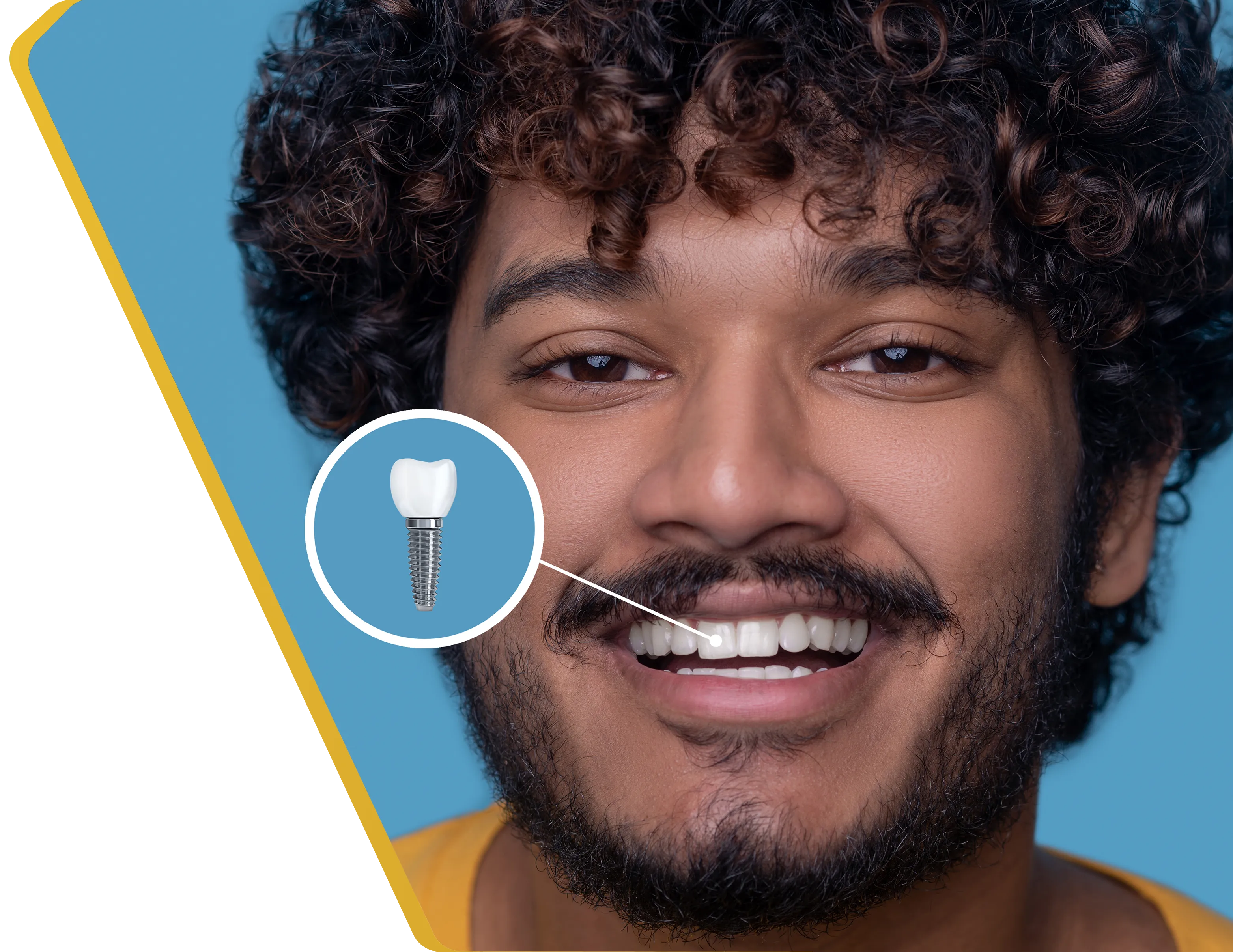 A patient's complete smile after a dental implant restoration at Dentistry at Millennium Park in Chicago