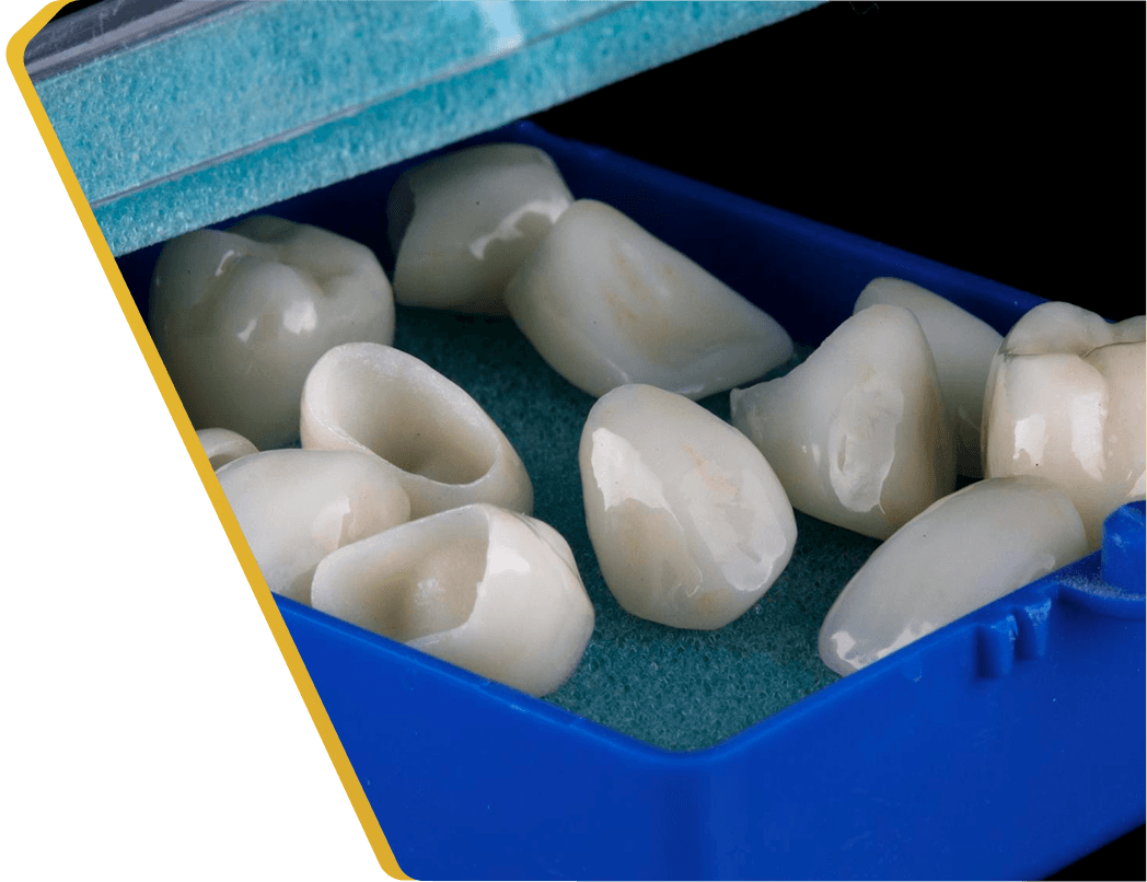 A patient's restored tooth after a natural-looking onlay at Dentistry at Millennium Park in Chicago