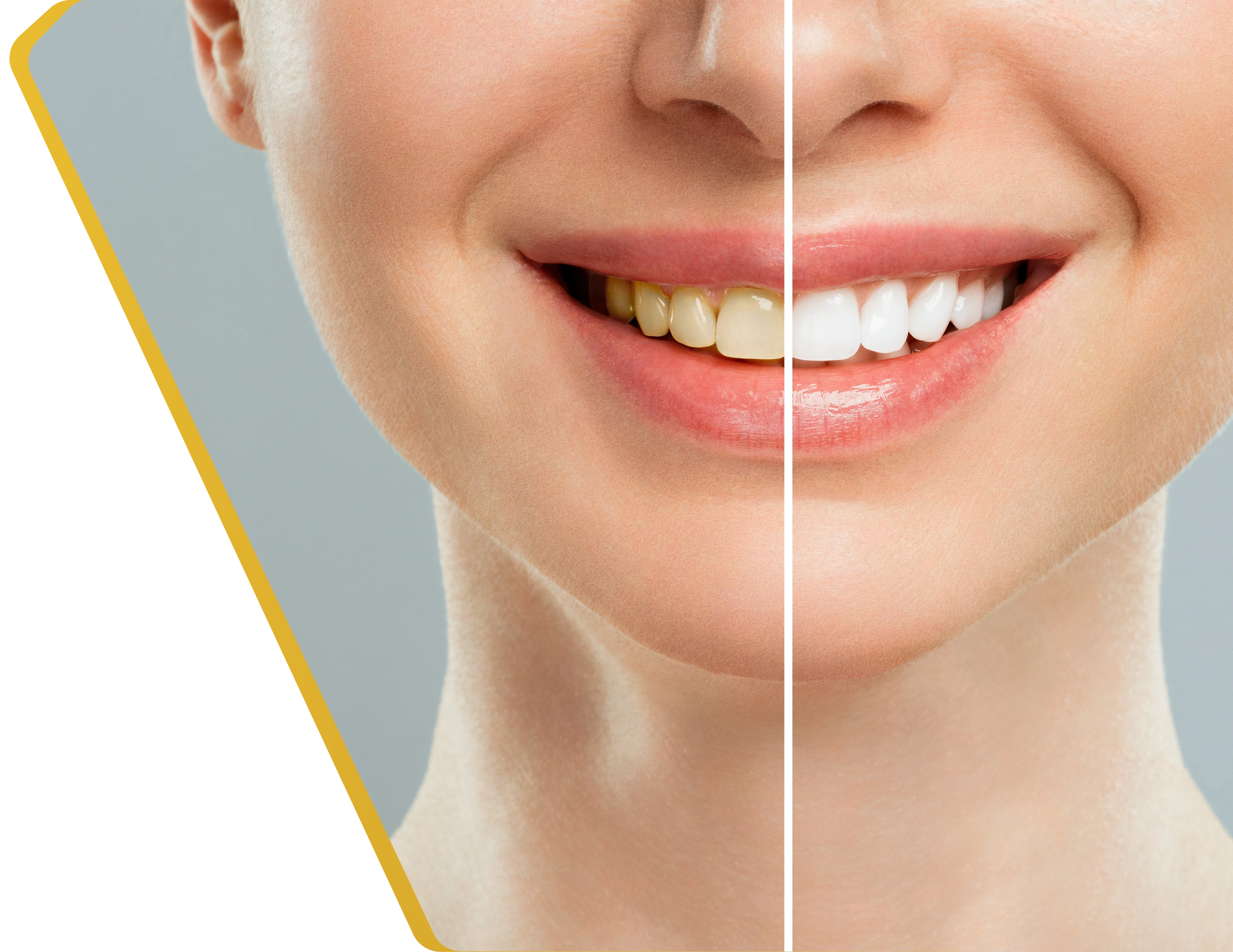 A patient's bright smile after professional teeth whitening at Dentistry at Millennium Park in Chicago