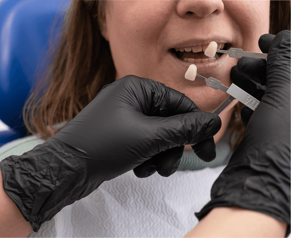 A patient's restored tooth after a natural-looking dental crown at Dentistry at Millennium Park in Chicago