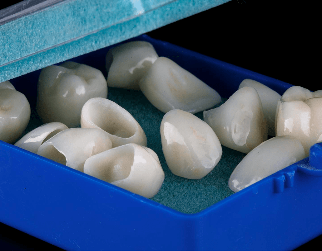 A patient's restored tooth after a natural-looking onlay at Dentistry at Millennium Park in Chicago