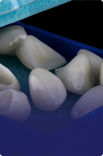 Inlays and Onlays