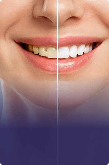 Teeth Whitening