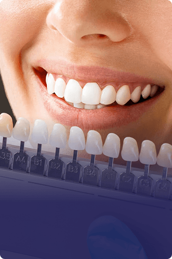 Veneers