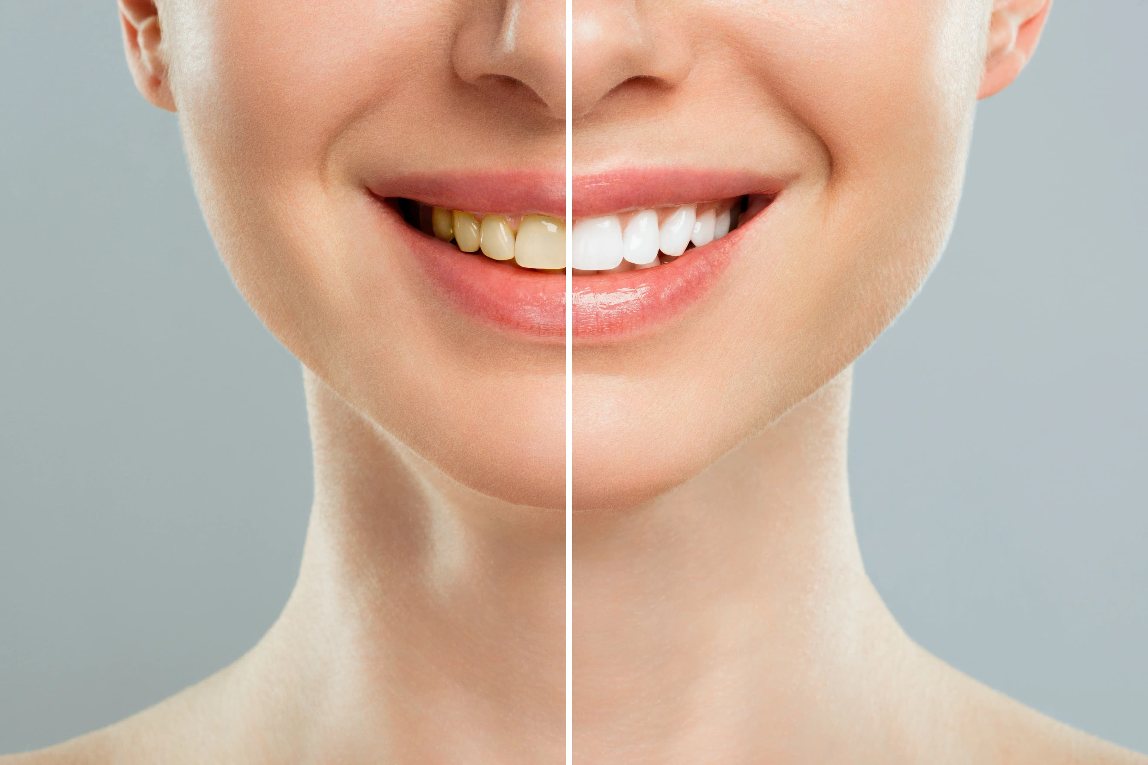 A patient's bright smile after professional teeth whitening at Dentistry at Millennium Park in Chicago