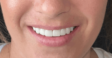 Smile after veneers