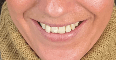 Smile before veneers