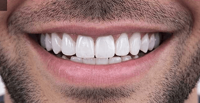 Smile after veneers