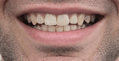 Smile before veneers