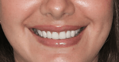 Smile after veneers