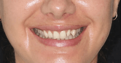 Smile before veneers