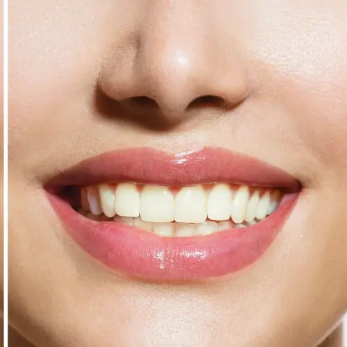 Before and after teeth whitening preview with FlashSmile