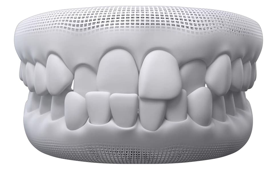 Crossbite dental model