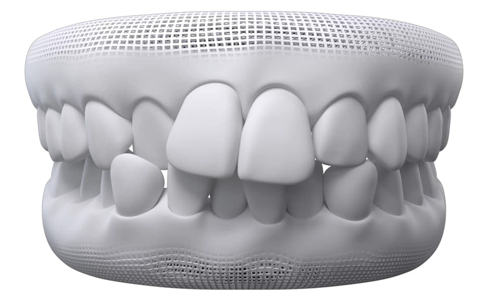 Crowded Teeth dental model