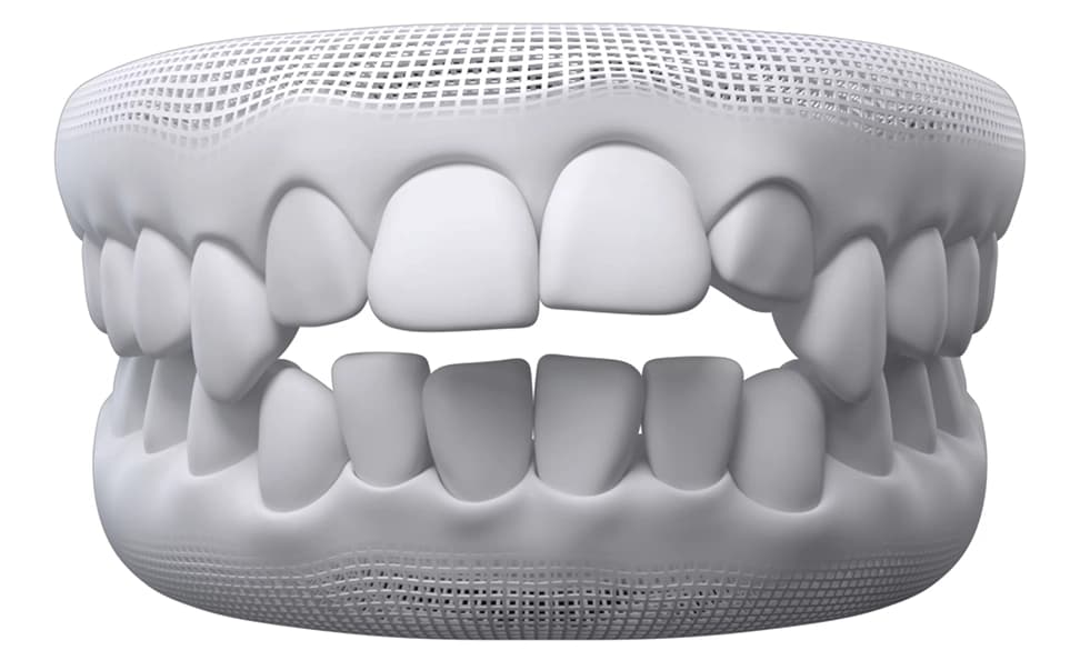 Openbite dental model