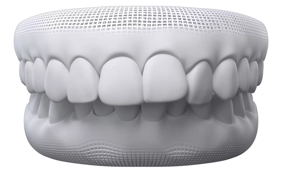 Overbite dental model