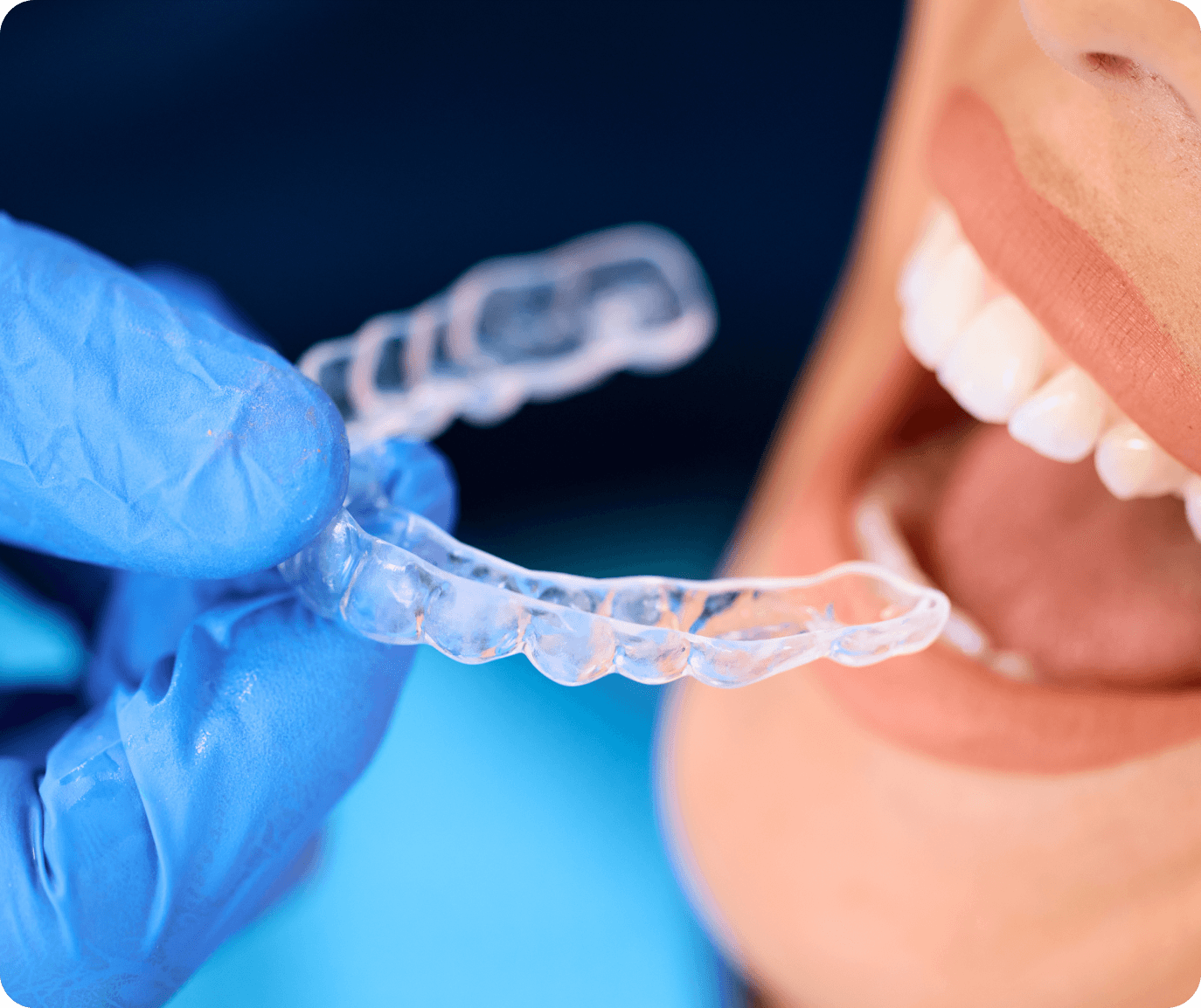 A patient having a clear aligner fitted