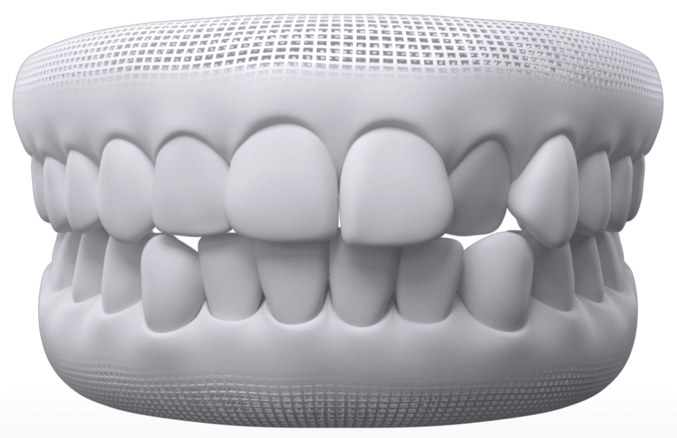 Generally Straighter Teeth dental model
