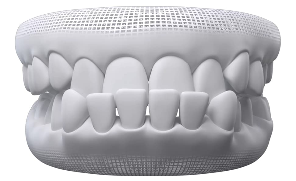 Underbite dental model