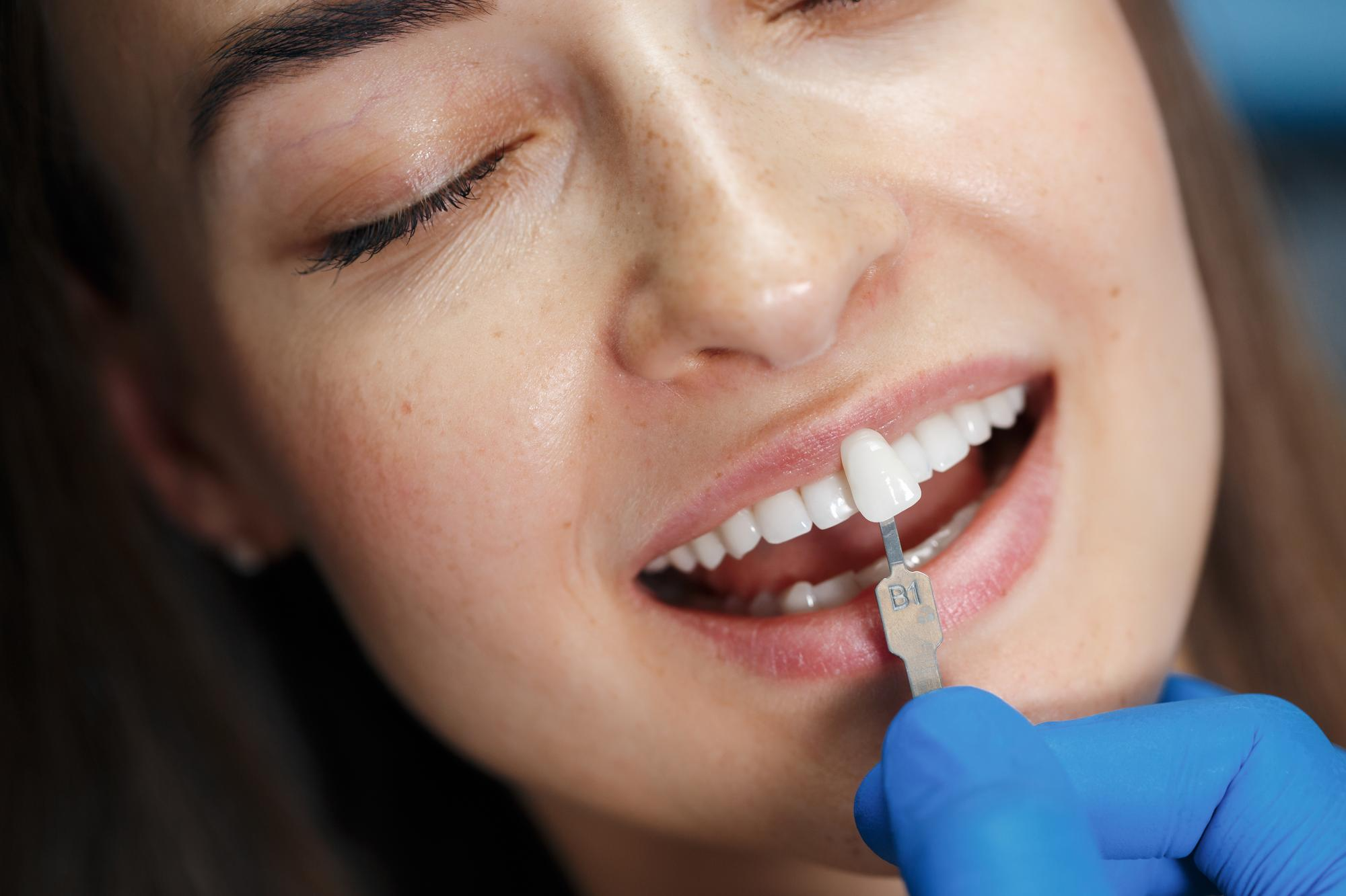 A natural-looking dental crown restoring a tooth