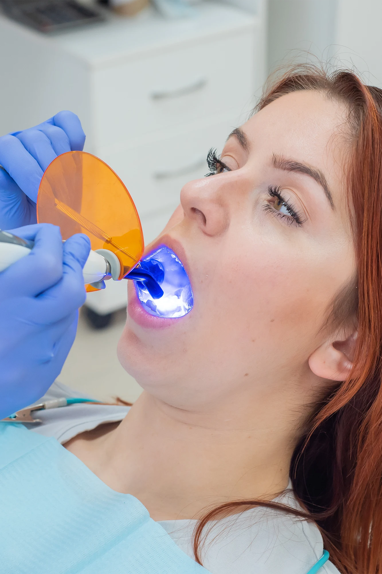 A tooth-colored composite dental filling