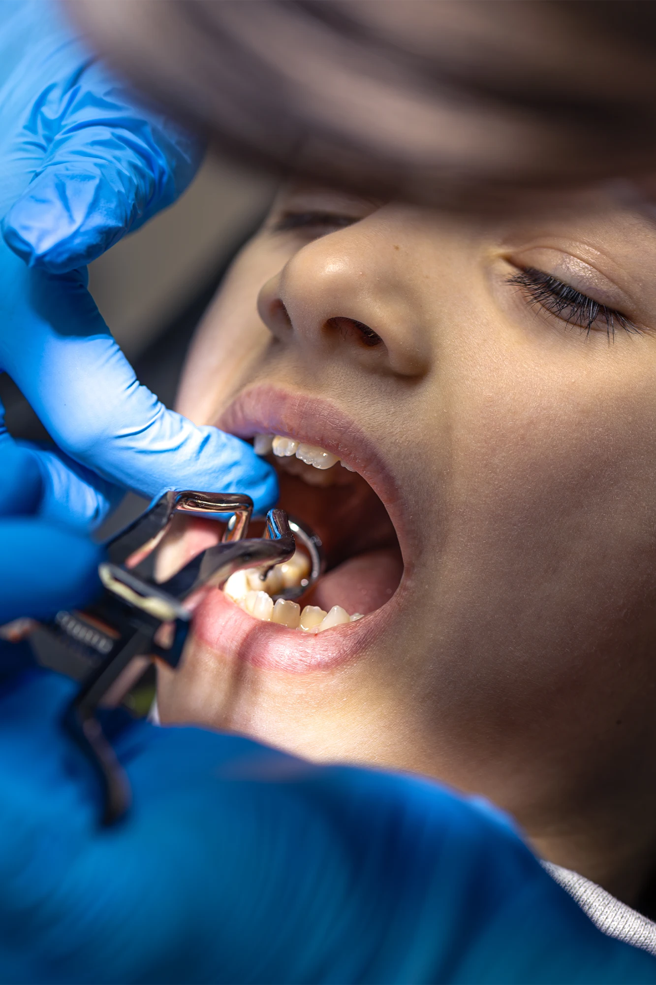 A tooth-colored composite dental filling