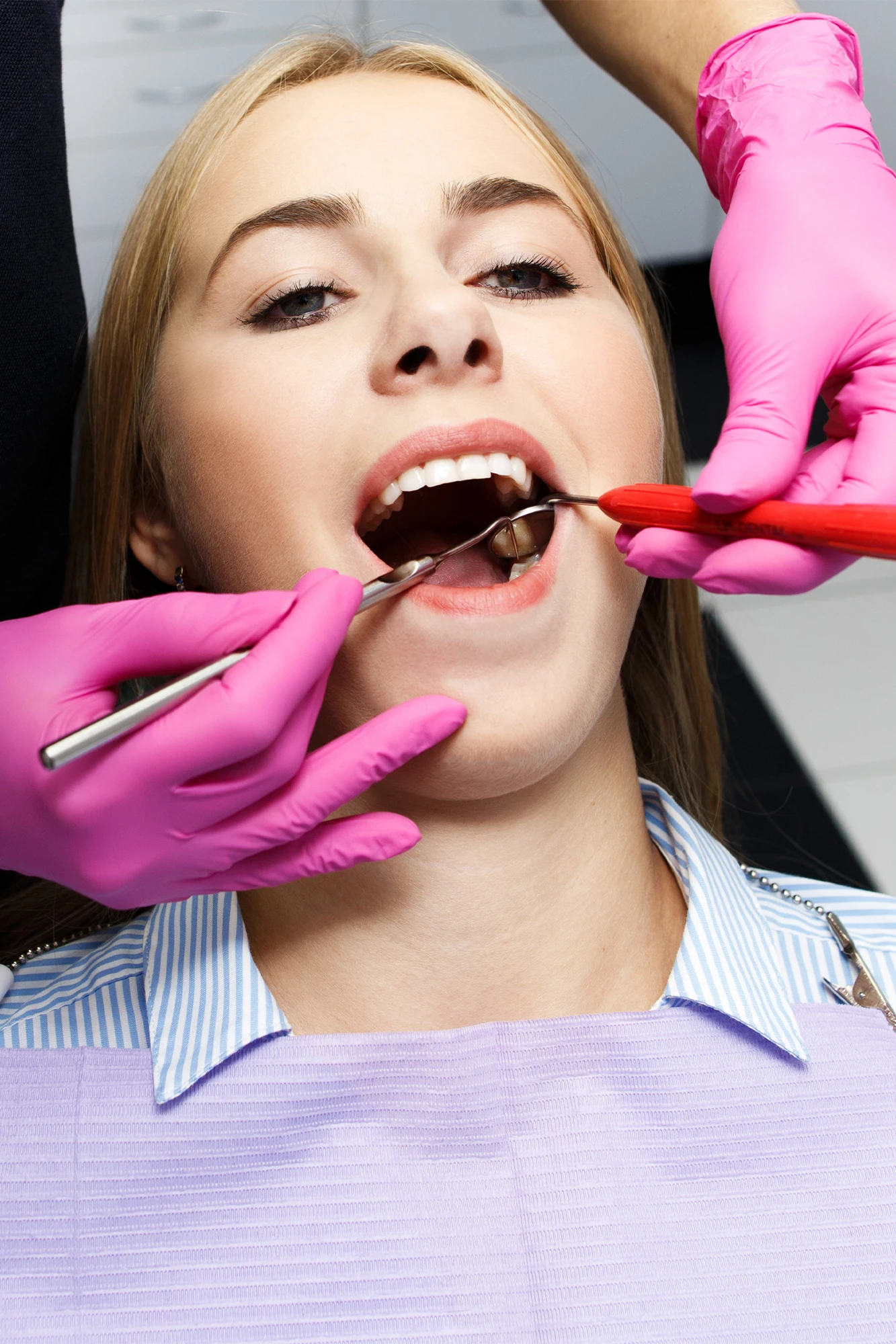 A protective dental sealant on a child's molar