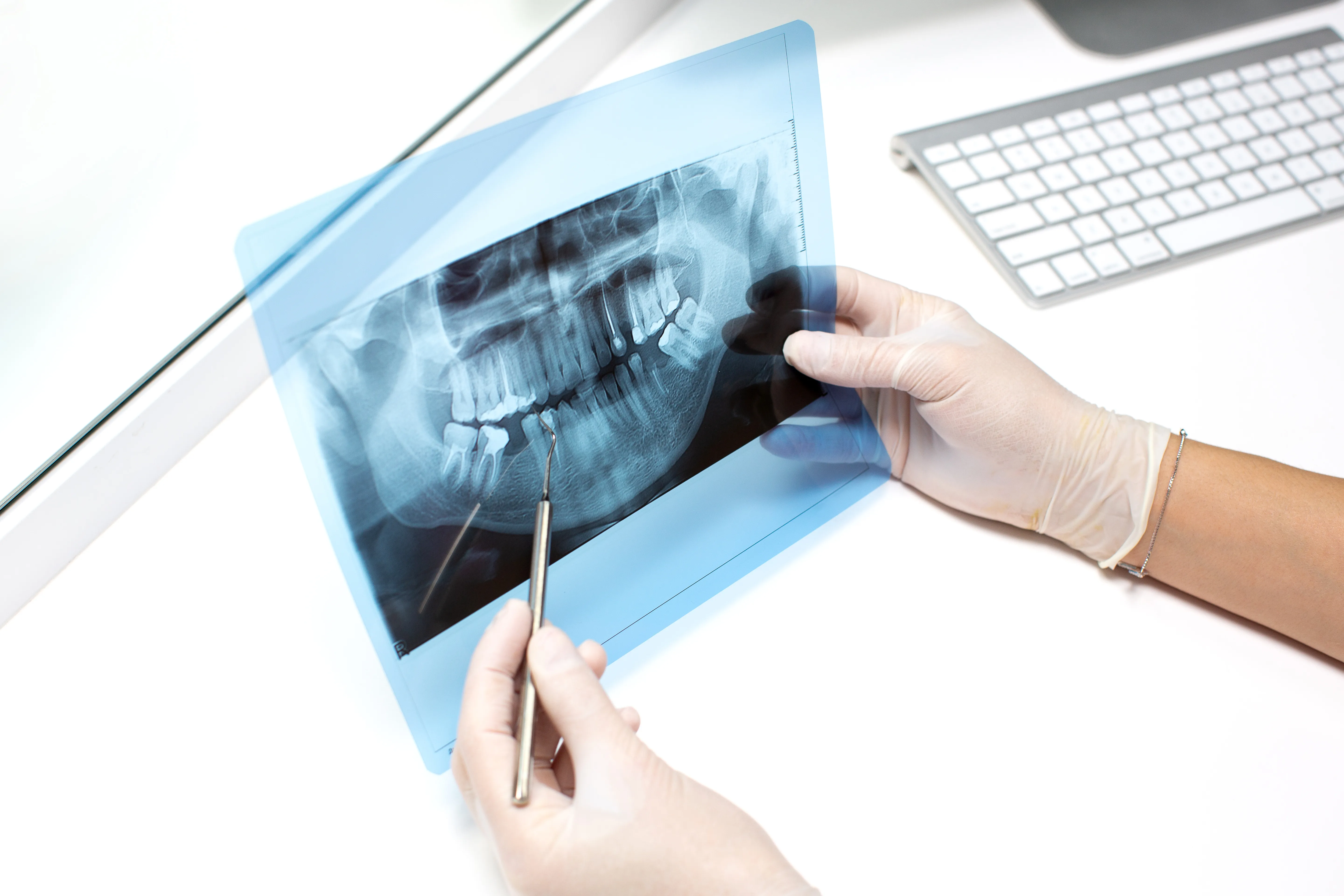 A detailed digital dental X-ray image on screen