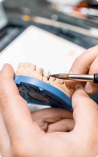 A tooth-colored porcelain inlay and onlay