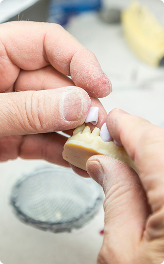 A tooth-colored porcelain inlay and onlay