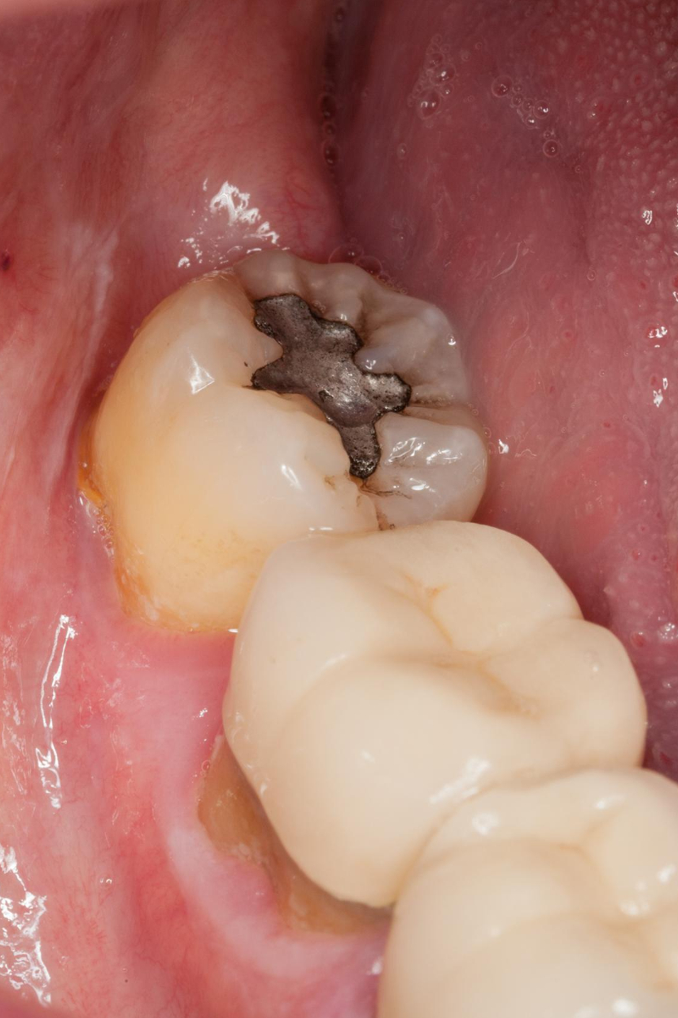 A natural, tooth-colored filling on a child's tooth