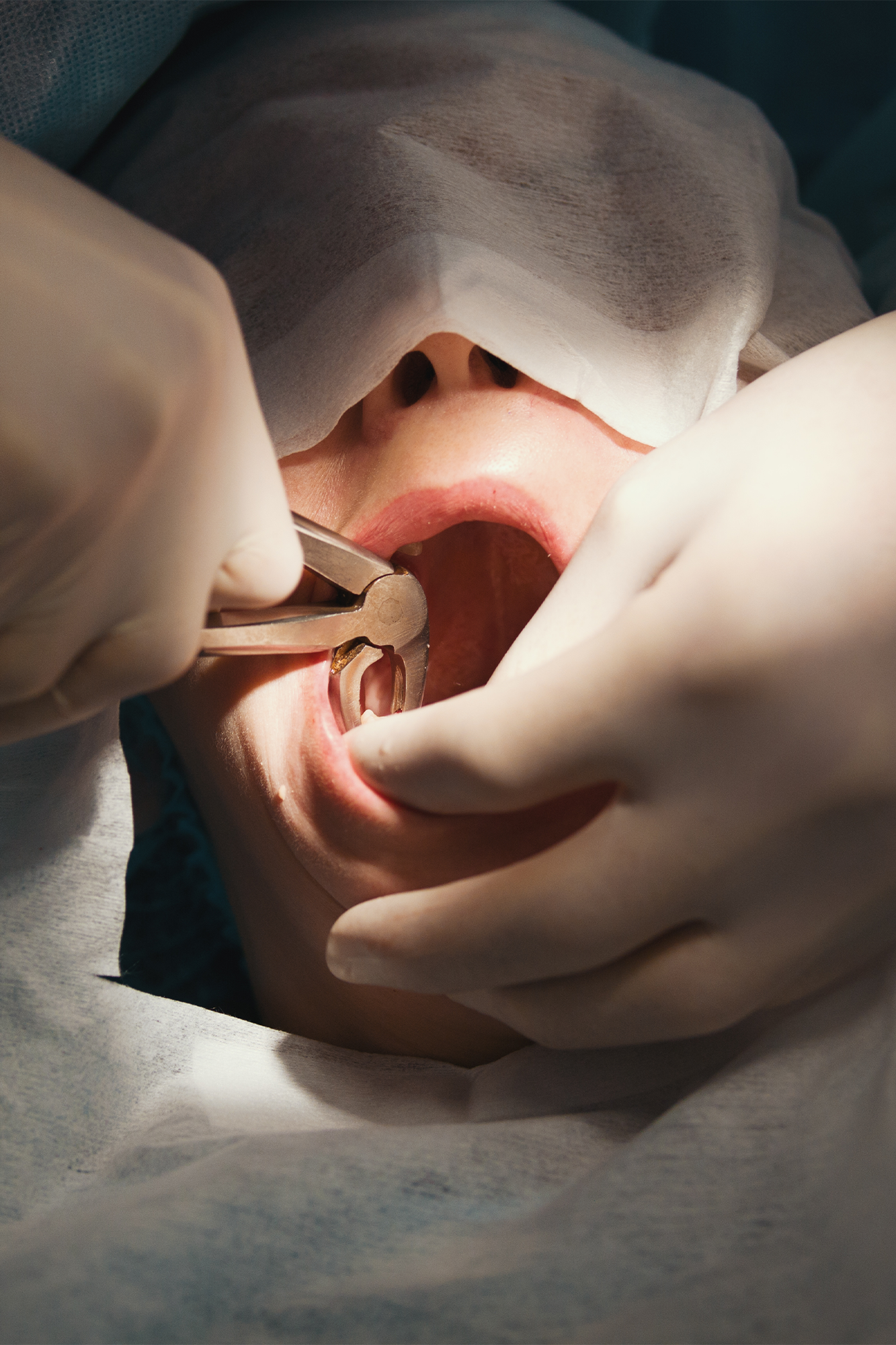 A gentle, simple tooth extraction