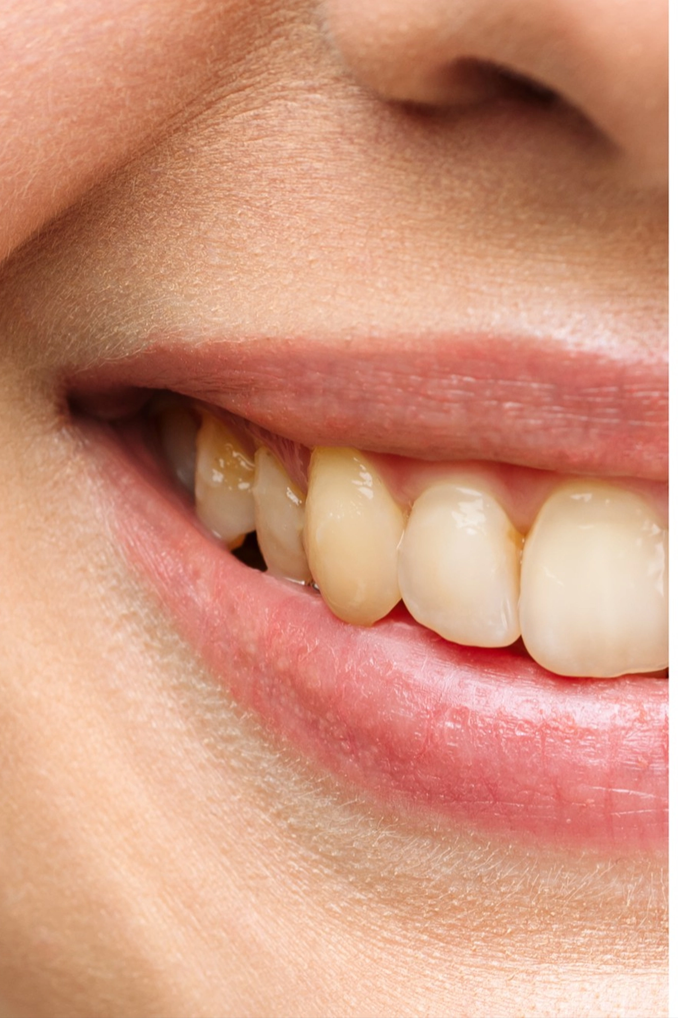 Professional teeth whitening treatment in a Chicago dental office