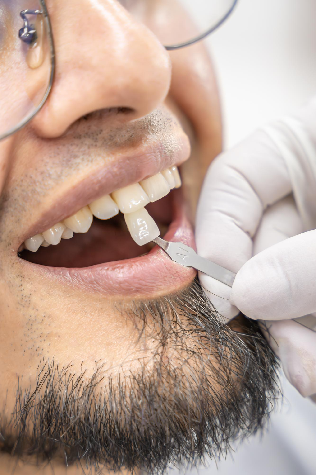 A patient's smile before veneers